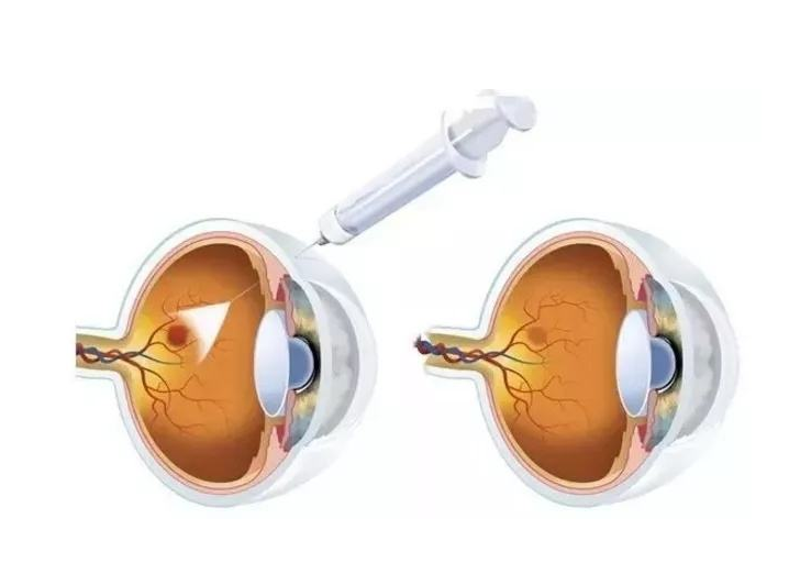 玻璃體腔注藥術（Avastin）手術