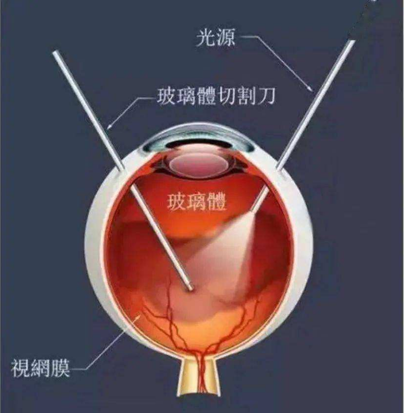 玻璃體切割手術