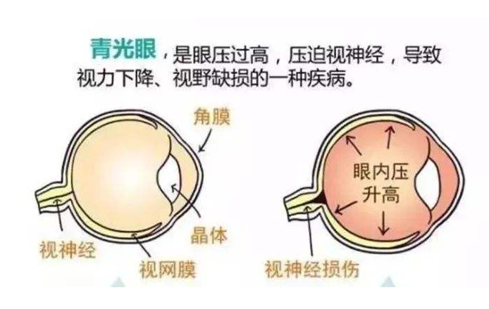 青光眼與白內障聯合手術