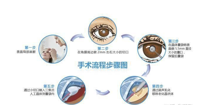 超聲乳化+人工晶體植入