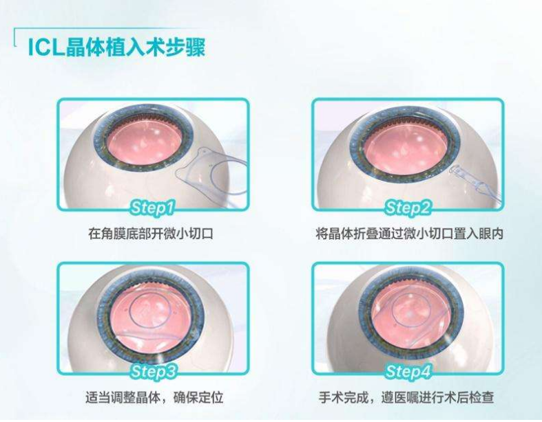 ICL晶體植入術