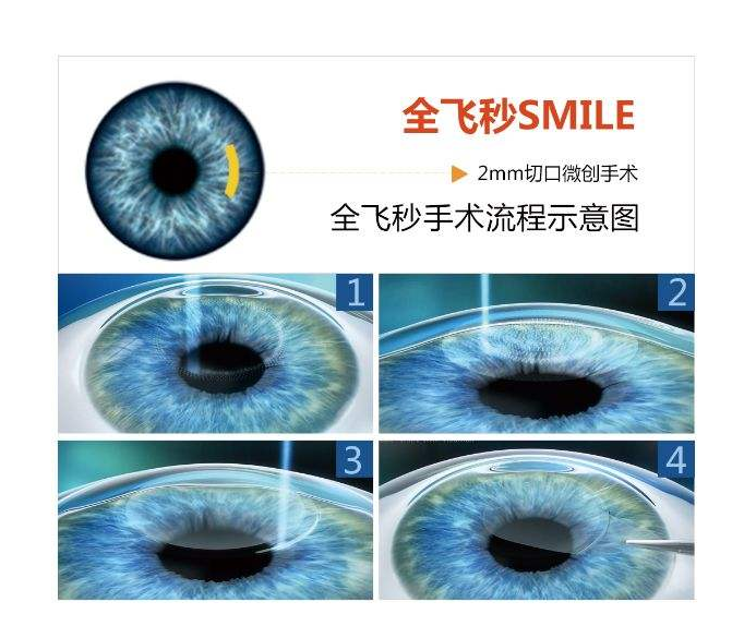 全飛秒激光