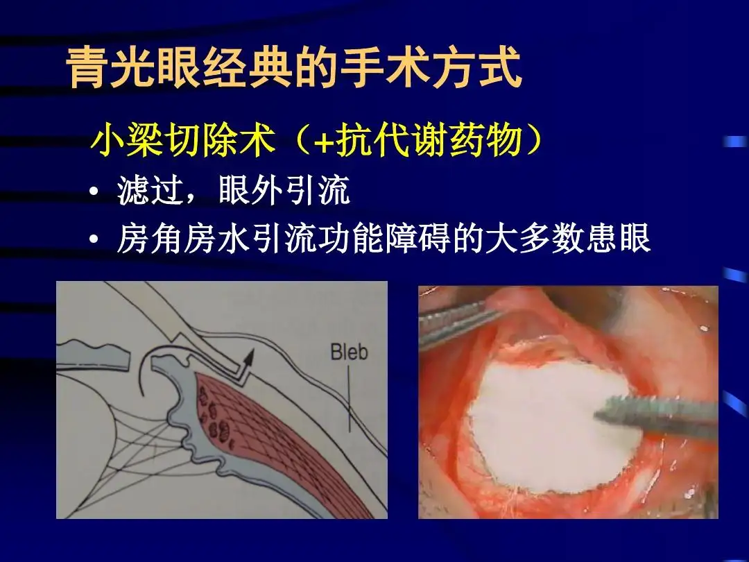 復合式小梁切除術