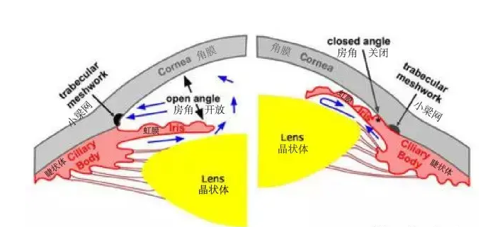 青光眼房角分離術