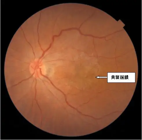黃斑裂孔修復術