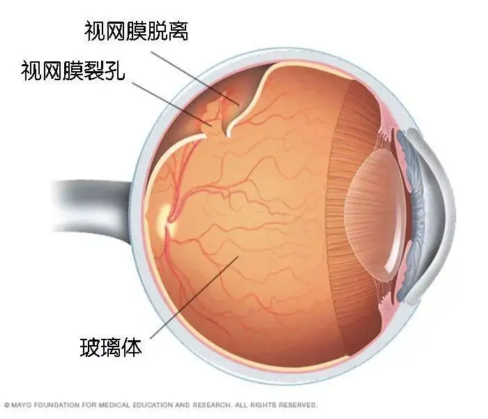 視網膜脫離復位術