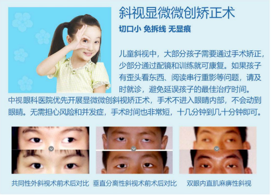 斜視矯正手術