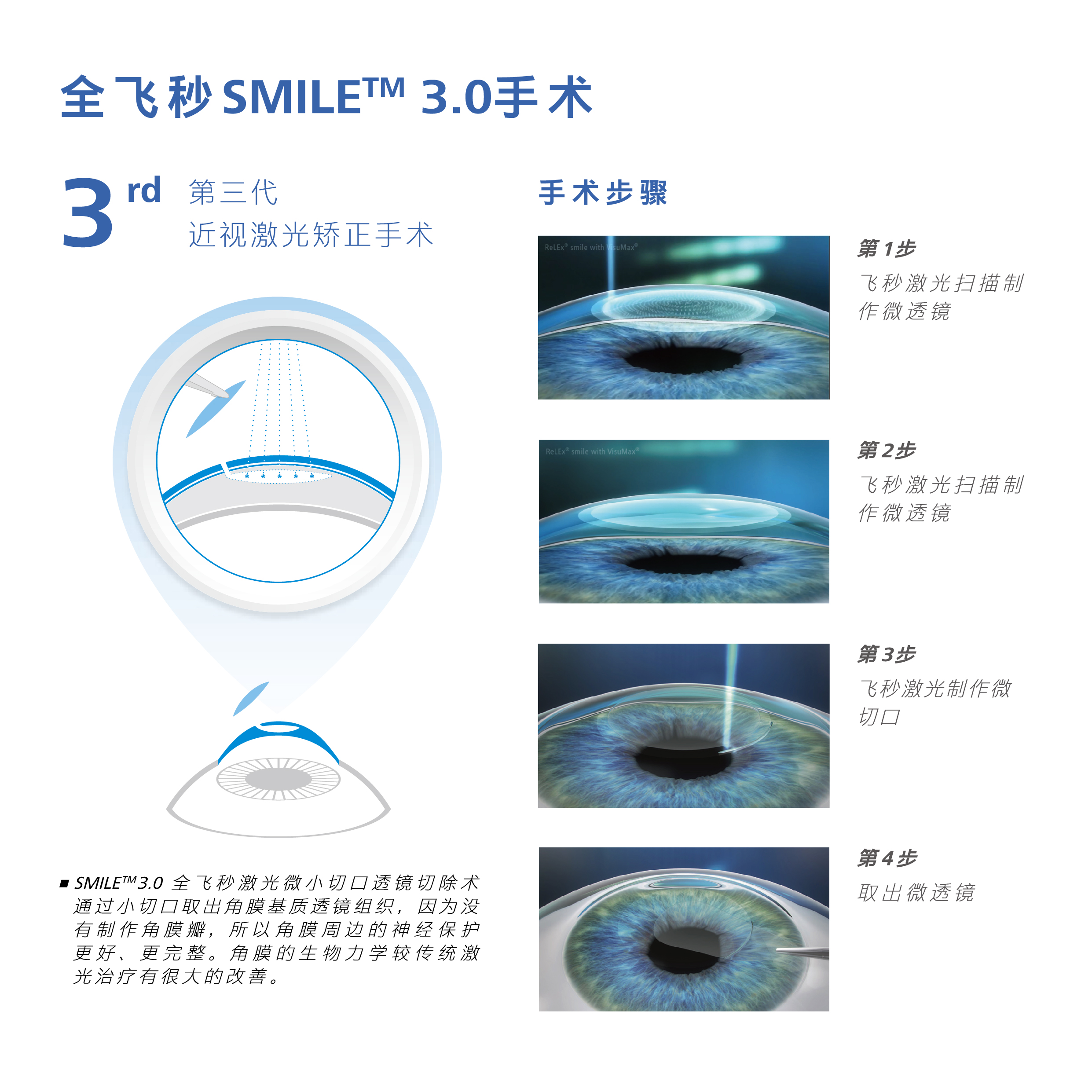 全飛秒手術-1-10